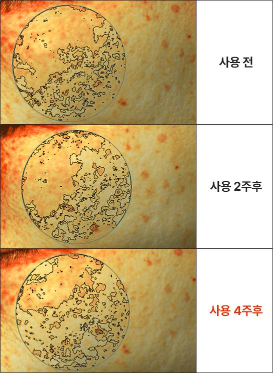 <p>Xác nhận giảm 19,8% diện tích tàn nhang</p>

